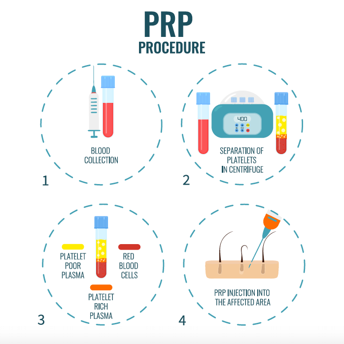 prp-procedure-infographic-template